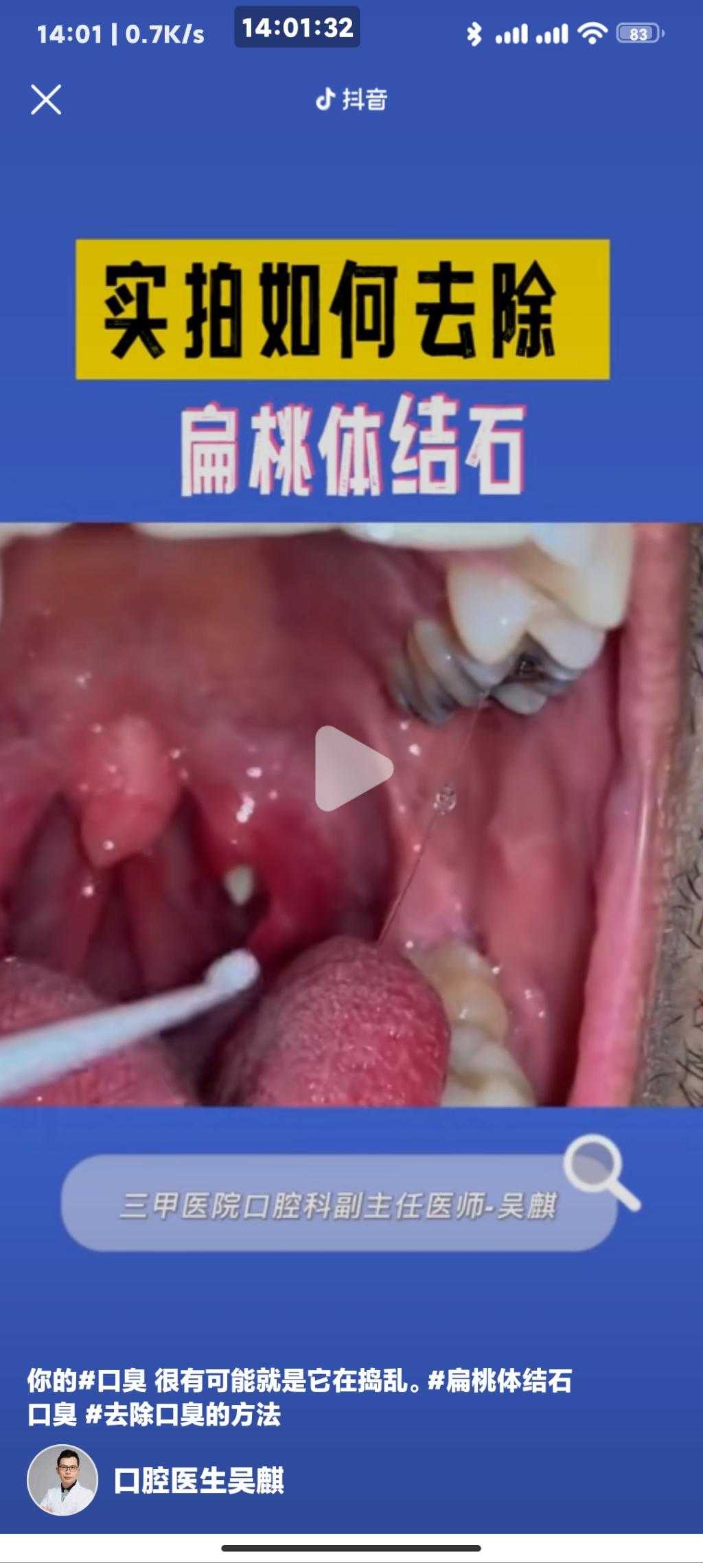 居然有好多吧友不知道扁桃体结石的，给你们科普下。