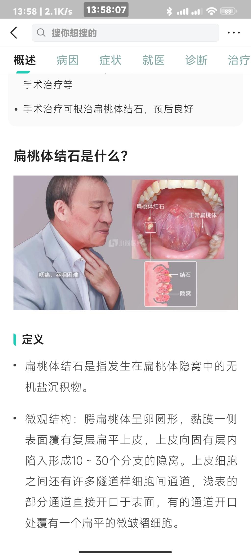 居然有好多吧友不知道扁桃体结石的，给你们科普下。