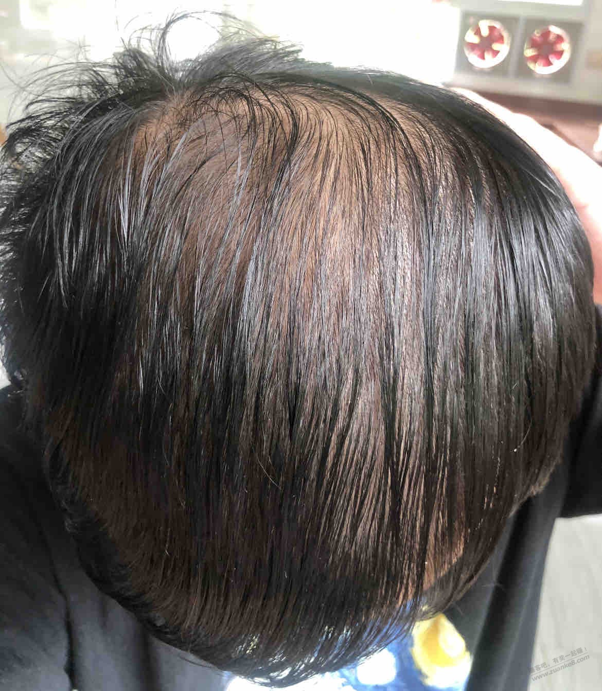 吃非那一年多了,秃头好了点,后悔吃晚了 吃非那一年多了,秃头好了点,后悔吃晚了