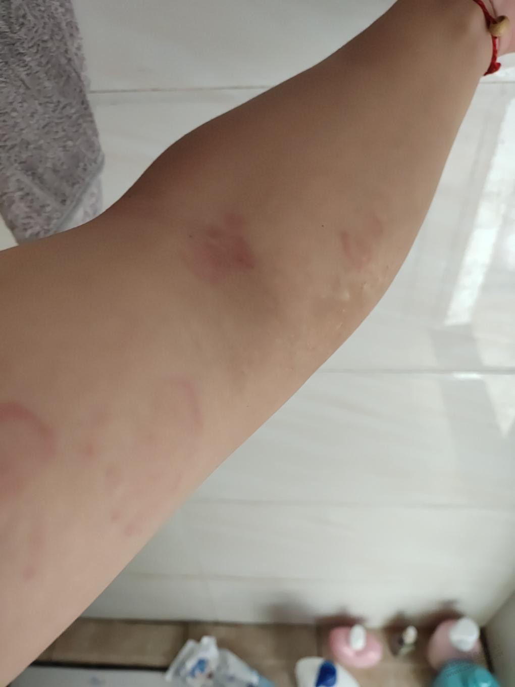 有过荨麻疹的吧友进来讨论讨论一下