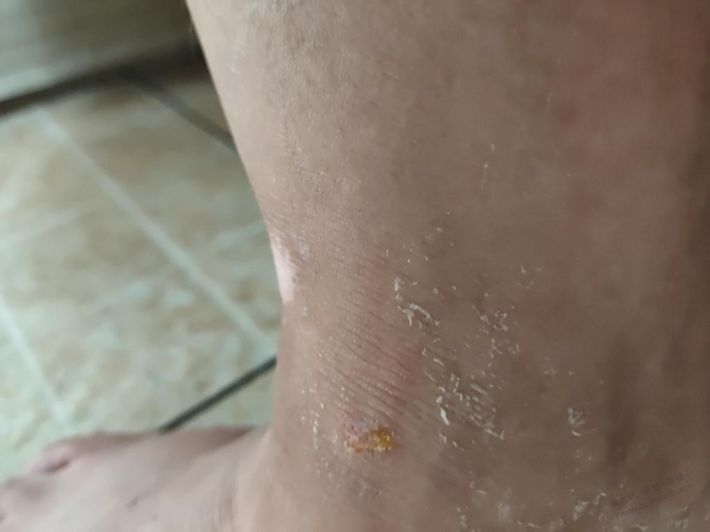 有过荨麻疹的吧友进来讨论讨论一下