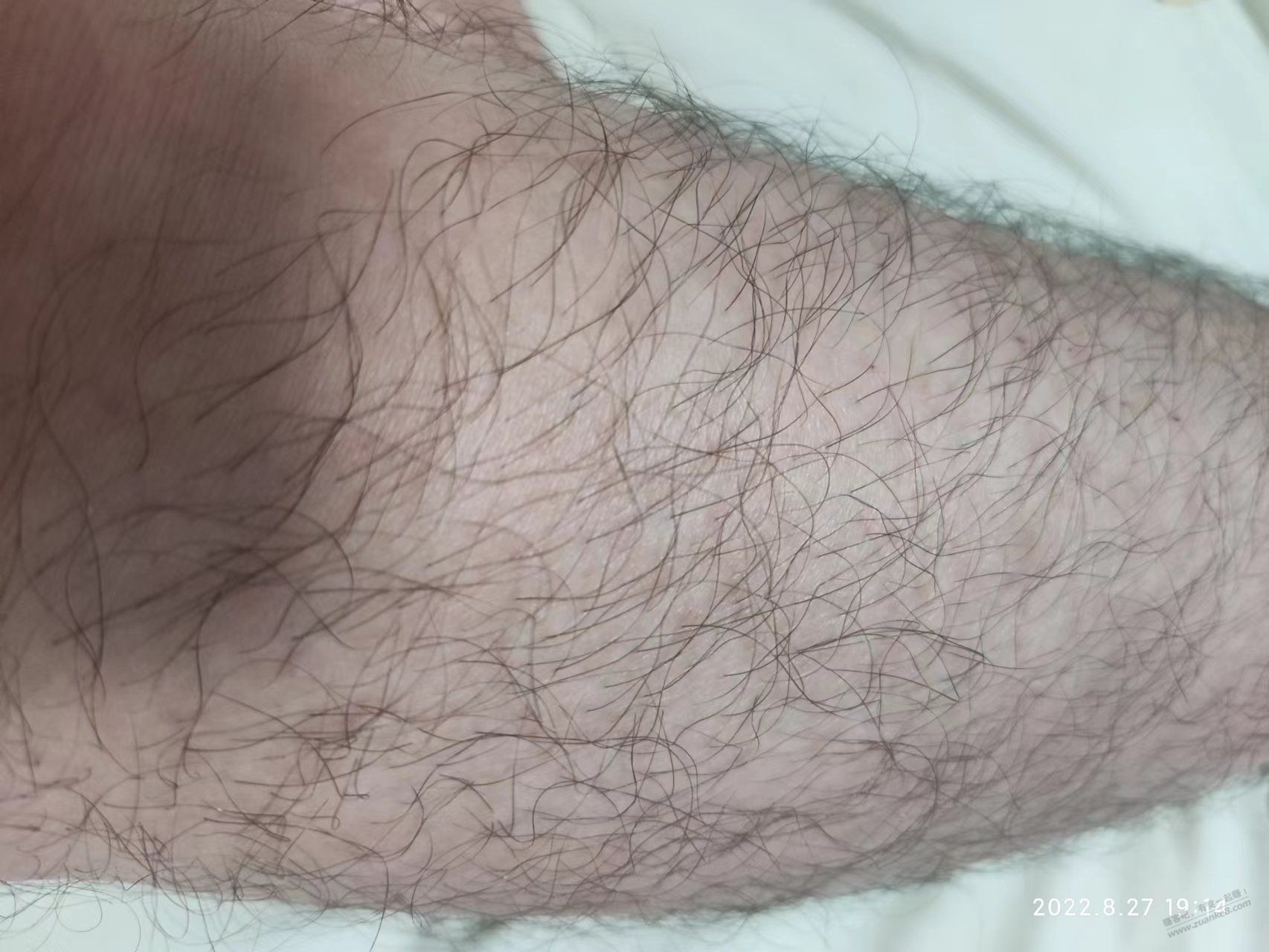 看到吧友脱毛，说说自己脱毛经历