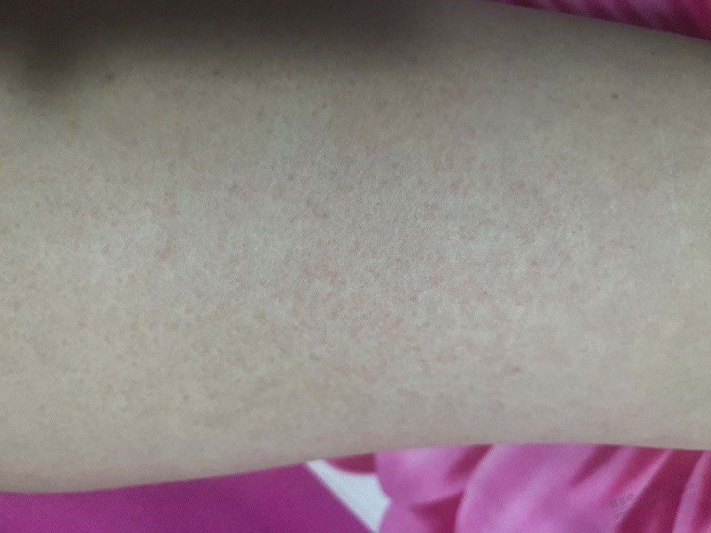 大腿出线很多红色小点点 - 0818团