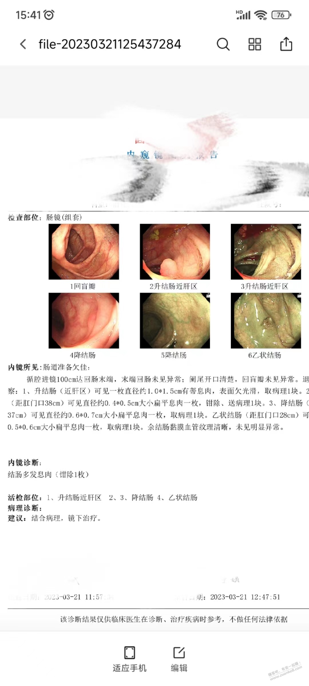 各位吧医看看 今天刚做的 肠镜检查 有个大息肉。只取了病理-惠小助(52huixz.com)