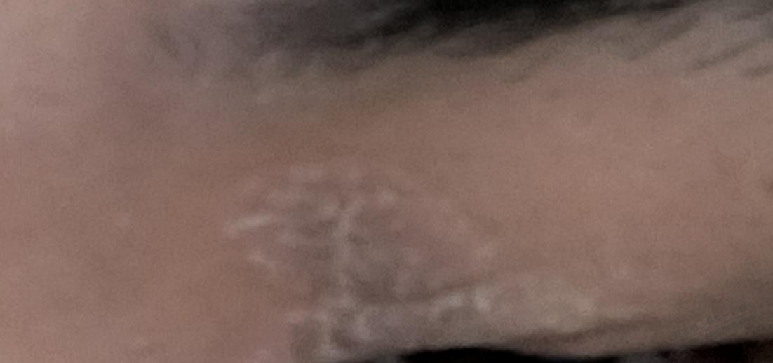 眼睛上这些是什么，涂什么药。脱皮，有两个月了，大神进来看看 - 线报迷