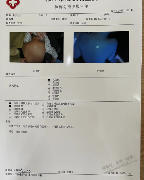 吧医请进，三岁女孩长这个白斑，有没有了解的 - 线报迷