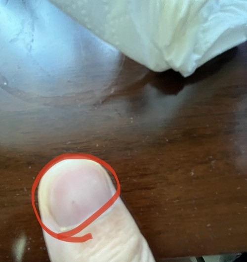吧医在吗，大拇指一周前里面出现个小黑点按压疼痛 - 线报迷