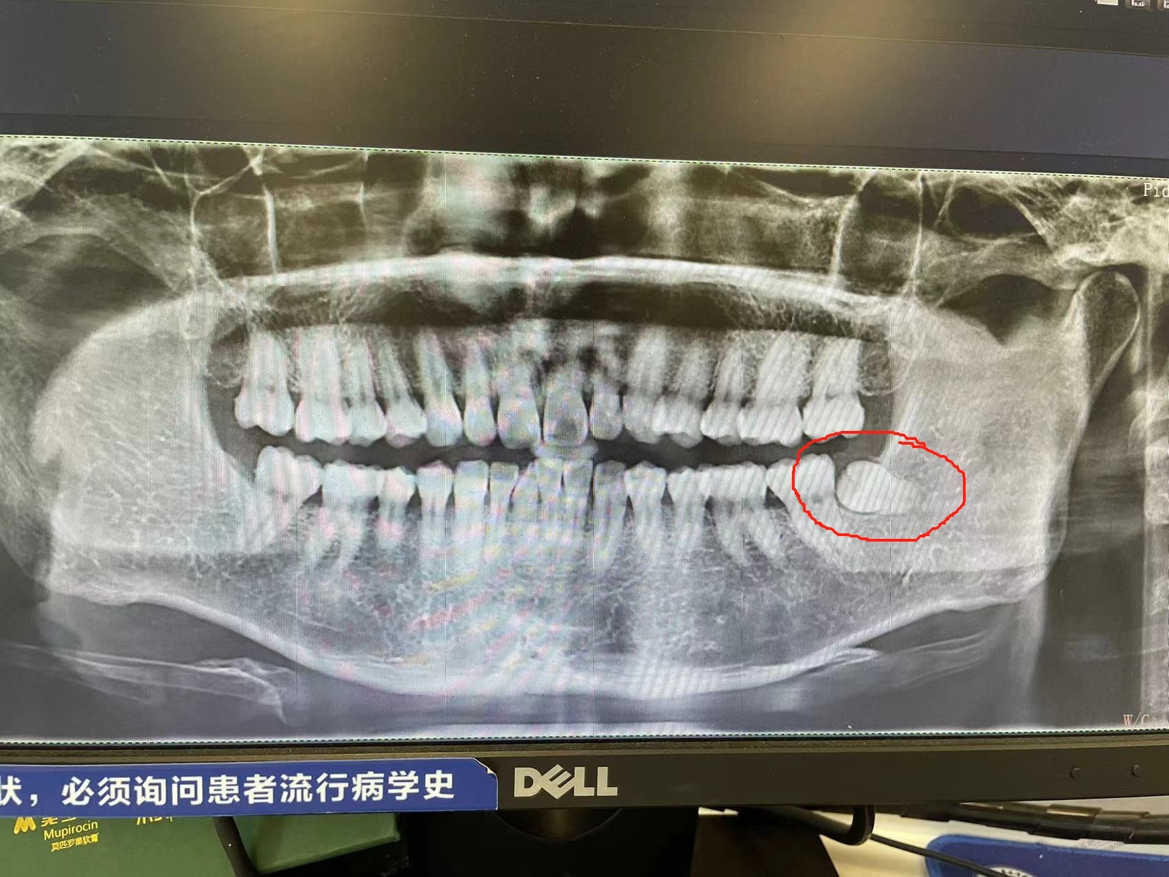 吧医 这个智齿要拔吗 目前不疼 也没感觉 - 线报迷