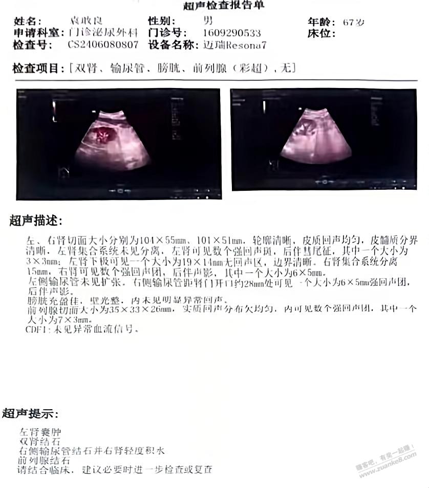 老丈人67岁一直有肾结石昨又犯病，去医院照了彩超（附图），这个严重吗？ - 线报迷