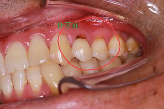 牙齿问题，楔状缺损，真的是刷牙造成的吗？ - 线报迷