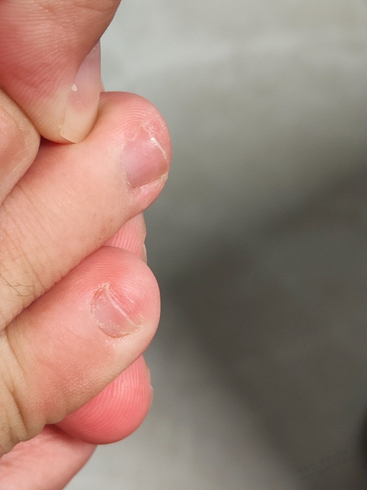 脚灰指甲真的治不好吗？越来越严重了，怎么办，吧友们，得过灰指甲 ，有没有治好的 - 线报迷
