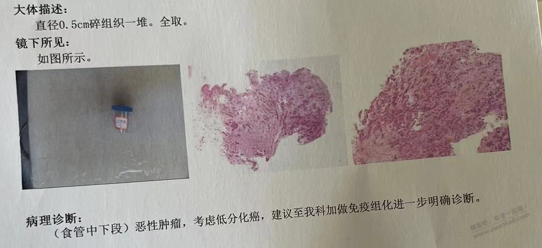 人生无常，老丈人检查出来食道癌，有懂的吗 - 线报酷