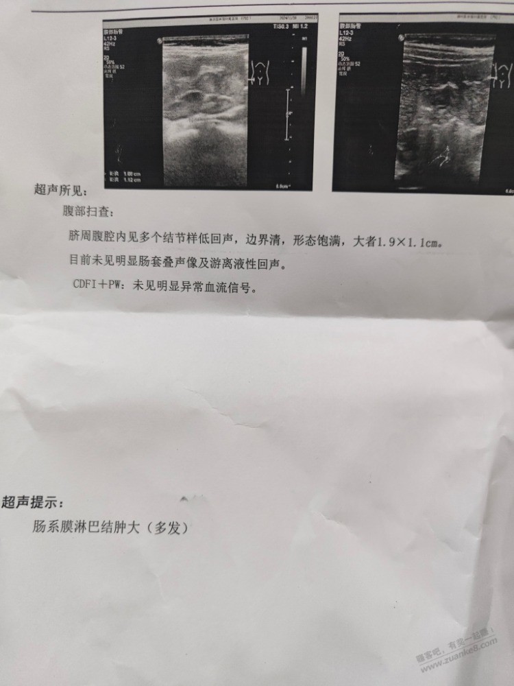 2岁半，发烧39度，医生让做了个彩超，肠系膜淋巴结肿大，严重吗？ - 线报迷