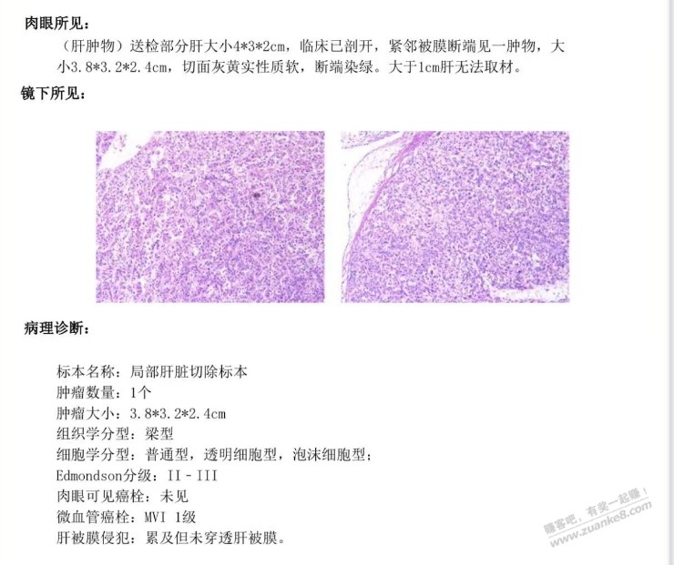 病理报告出来了 有能看的懂的吗 - 线报迷