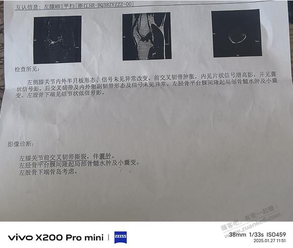 吧友帮我看看我膝盖的核磁共振。 - 线报迷