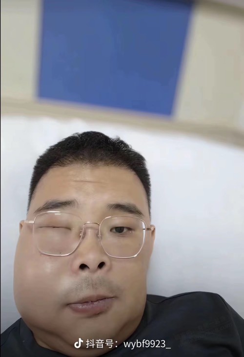 拔牙后几天真难熬 阻生智齿 帮助大家下次搜索有数据 - 美泡泡
